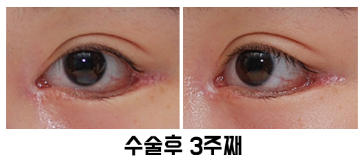 속눈썹 찌름 - 안검내반 교정 최소절개 흉터에 대해 관련 이미지 6