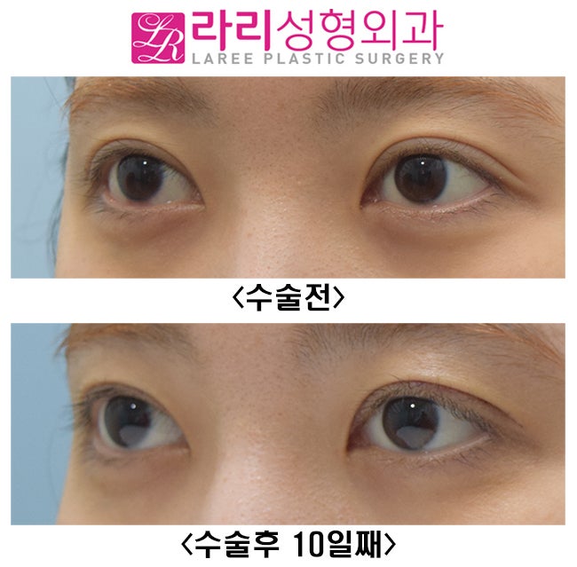 [Lari Plastic Surgery] Double Eyelid Revision Surgery with Line Lowering Combined with Ptosis Correction Surgery image 1