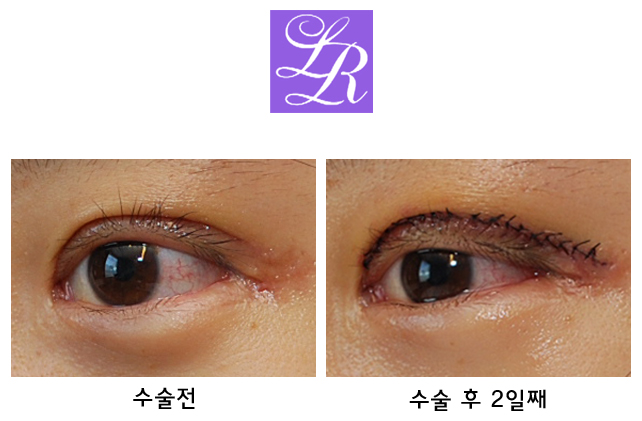 Upper Eyelid Double Eyelid Surgery, Eyelid Eversion (Mucosal Show, Eyelash Elevation) - Rapid Correction image 3