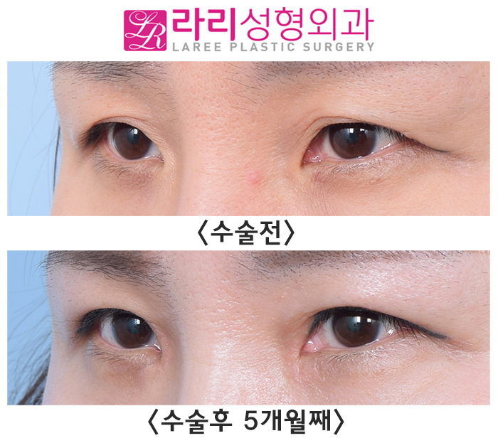 [라리성형외과] 자연스러운 속쌍꺼풀 절개눈매교정, 앞트임수술 전후사진 관련 이미지 4