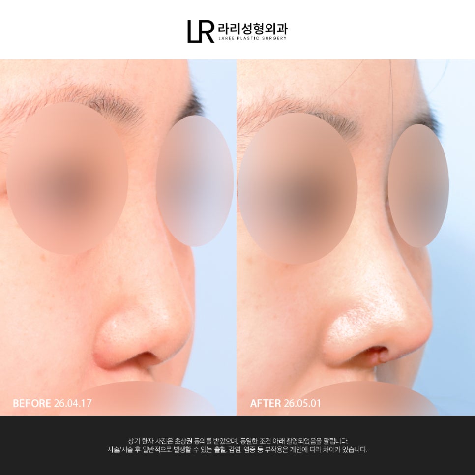 [Lari Plastic Surgery] If You Are Considering Nose Surgery, Do Not Get Nose Thread-Lifting Procedures Like Misko / Hiko!! image 2