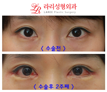 Epicanthoplasty: Is It Worth the Cost? image 4