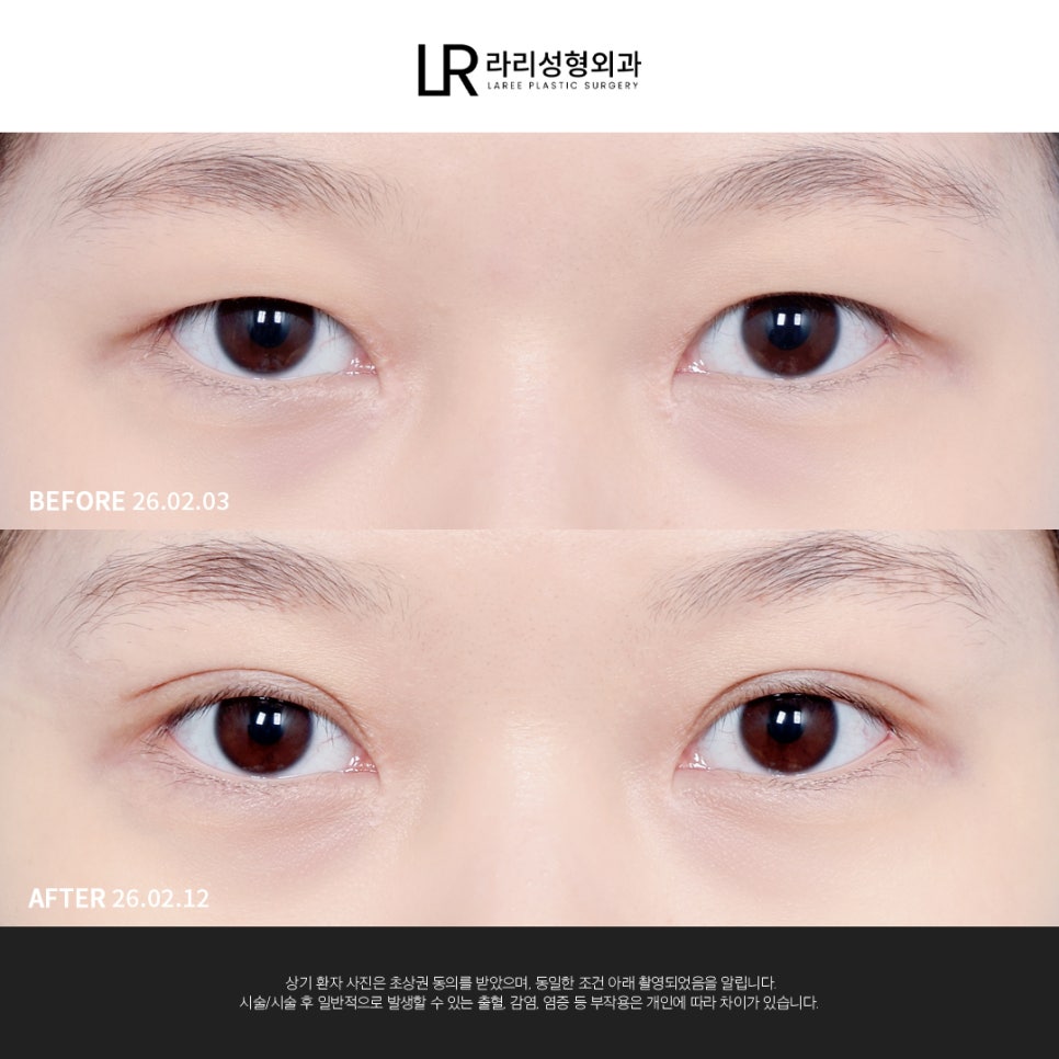 [라리성형외과] 눈 첫성형은 빠르고 간단한 매몰쌍수로 관련 이미지 2