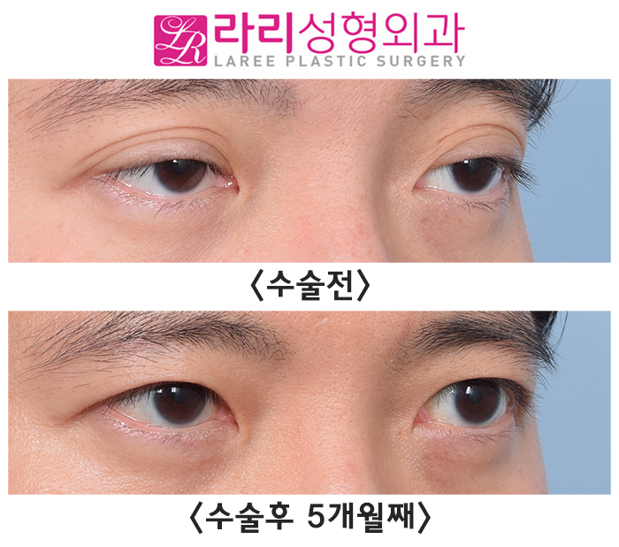 [라리성형외과] 쌍꺼풀없애기와 눈매교정수술의 콜라보 (+ 눈도 잘 감겨요) 관련 이미지 3