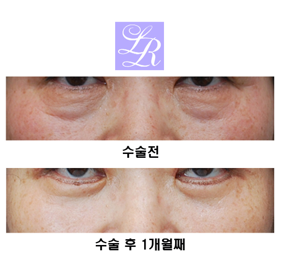 하안검수술,잘 알고 시행해야 관련 이미지 3