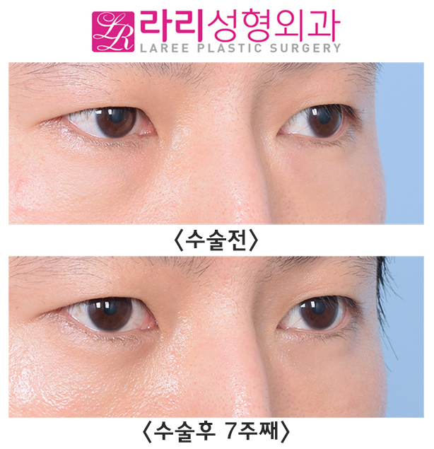 [Lari Plastic Surgery] Check for Undetected Under-Eye Fat and Solve It with Under-Eye Fat Repositioning. image 3