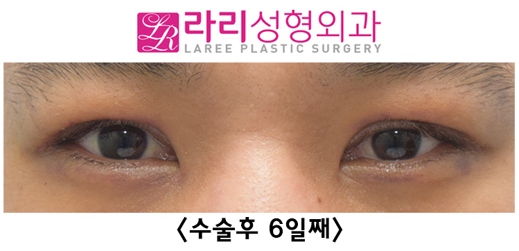 [Lari Plastic Surgery] See the Process of Correcting Uneven Eyes After Double Eyelid Removal Surgery image 2