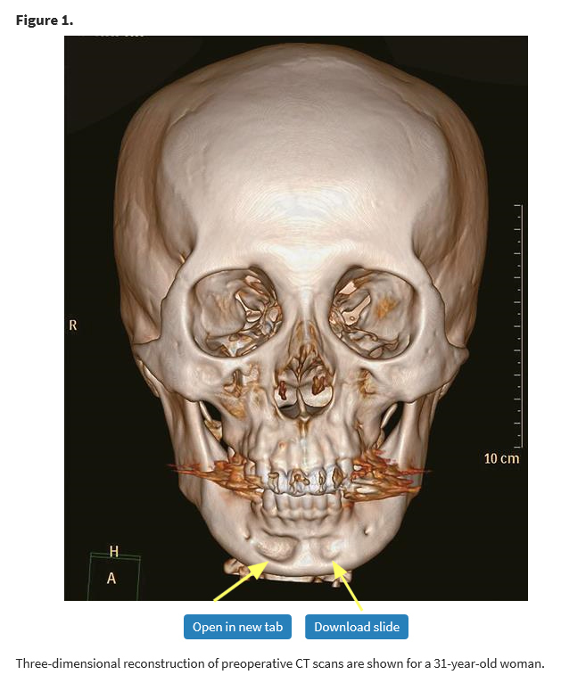 “Filler Side Effects? Characteristics? You Really Need to Be Careful with Fillers. A Plastic Surgeon Personally Sees Filler Side Effects” A Close Analysis of the Bone Depression Controversy in the Video! (feat. Chinese Paper) - 2 image 7