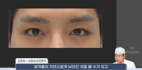 [라리성형외과] 쌍꺼풀재수술 라인 낮추는 두 가지 수술법 (절제방법 , 두줄따기방법) 관련 이미지 9