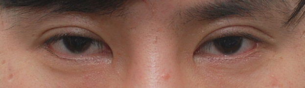 Review of Double Eyelid Removal Surgery + Epicanthic Fold Hook Removal Inner Corner Surgery image 1