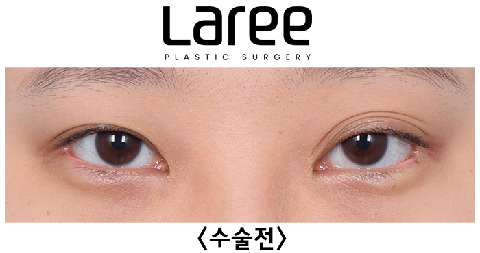 [Laree Plastic Surgery] One-Sided Release After Buried Double Eyelid Surgery, Multiple-Fold Double Eyelid Revision Surgery and Changes After Eyelid Correction image 1