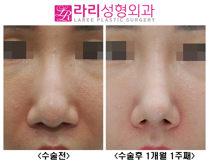 [Rari Plastic Surgery] Nose Bridge and Tip Surgery After Hyco Removal image 1