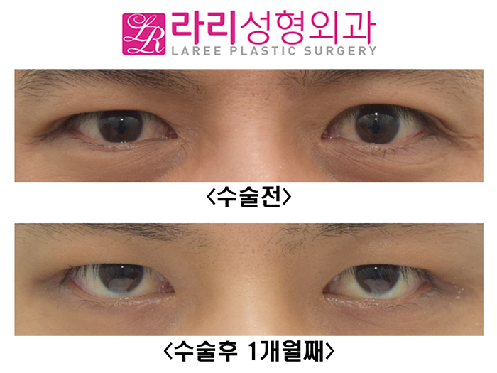 [라리성형외과] 눈크기 짝짝이 교정 수술 전후사진 관련 이미지 1