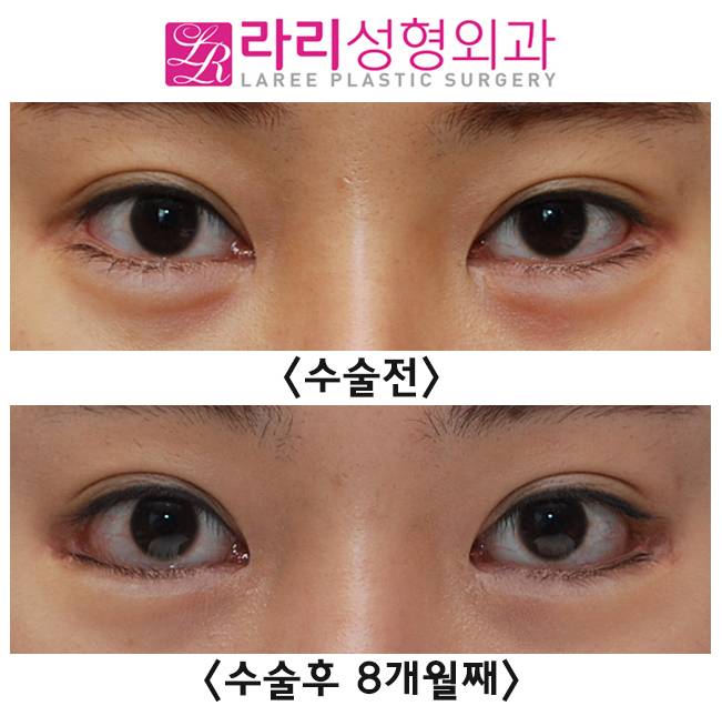 [라리성형외과] 벌어짐 없는 앞트임 미세복원 관련 이미지 1