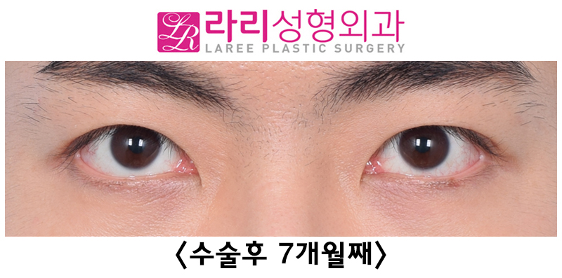 [라리성형외과] 쌍꺼풀없애기 수술 눈안감김(토안)의 원인이 정말 피부절제 때문일까? - 무절제쌍꺼풀없애기 관련 이미지 19