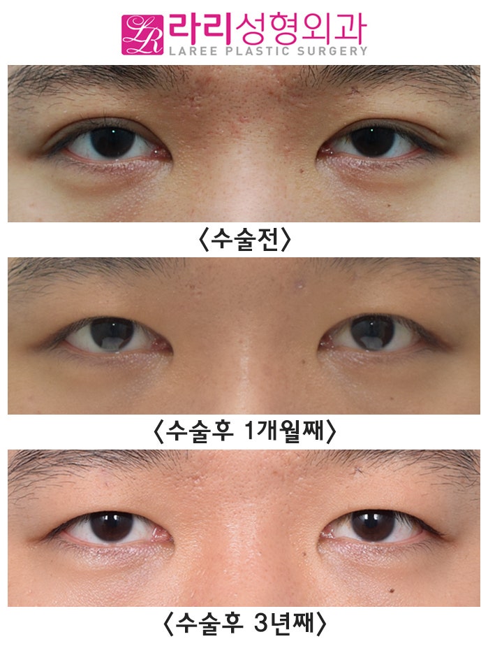 [Rari Plastic Surgery] Causes of Uneven Eye Size After Double Eyelid Removal Surgery, Cases That Naturally Even Out, Before-and-After Photos image 3