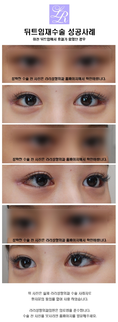 뒤트임재수술 - 첫수술이 효과가 없던 경우, 부작용? 관련 이미지 3
