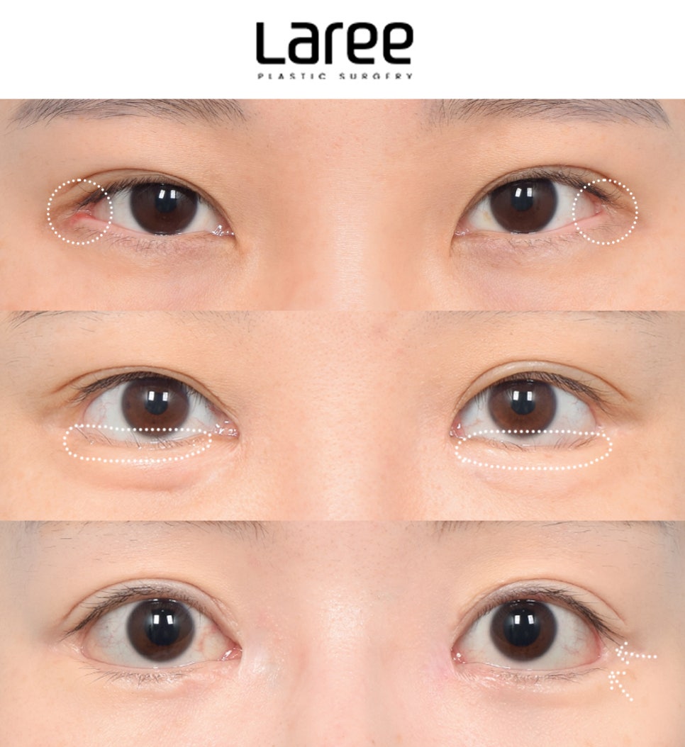 [LaLi Plastic Surgery] Outer Canthus Lowering Surgery, If It’s a Revision Surgery, It Must Be Done at a Place That Does It Well. image 3
