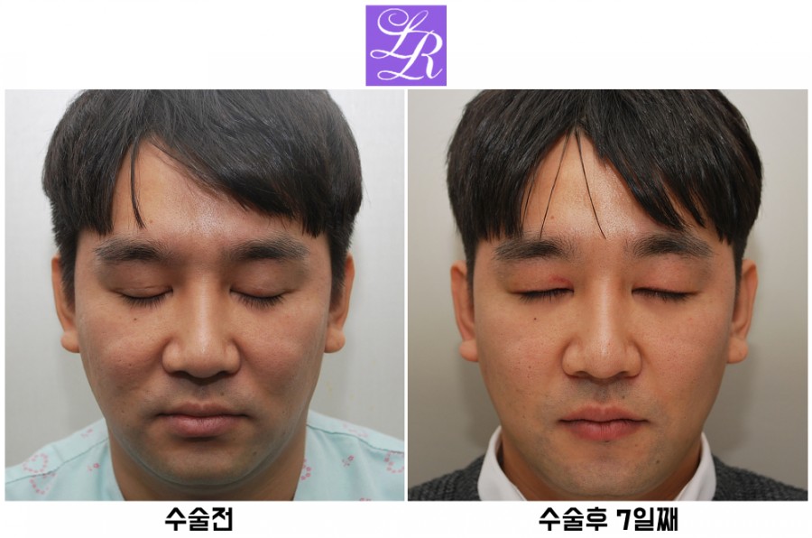 쌍꺼풀푸는수술 후기 - 수술후 1주일차 붓기, 멍 경과 관련 이미지 2