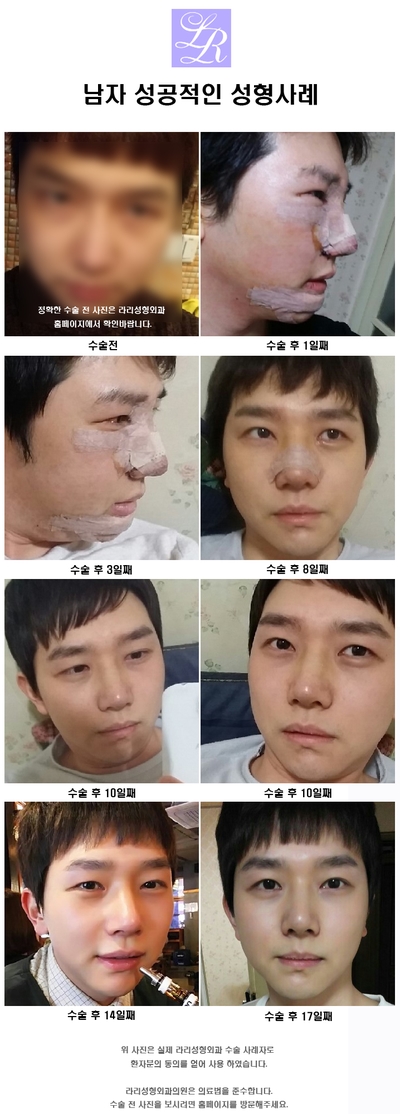 Are You Curious About Canthoplasty for Men? image 1