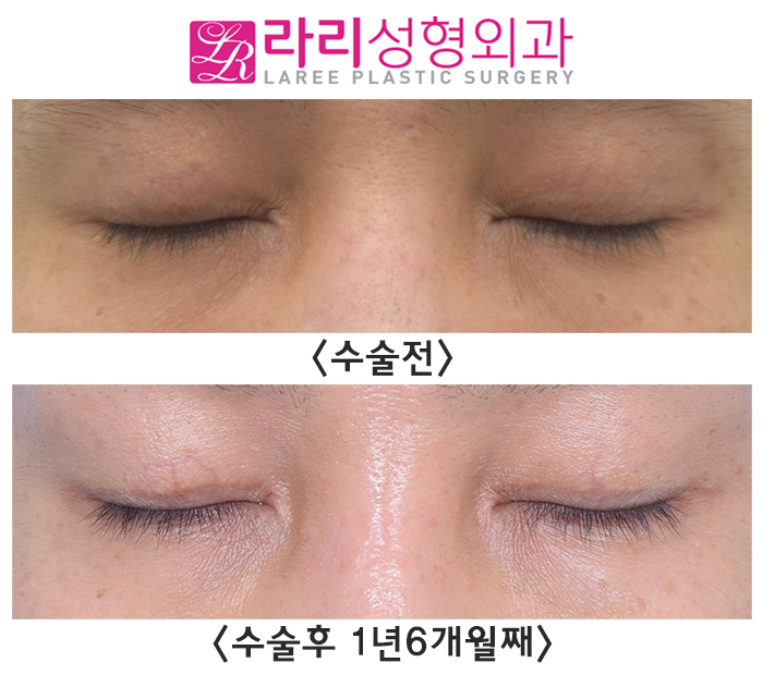 [라리성형외과] 쌍꺼풀없애기 ? 쌍꺼풀라인낮추기 ? 고민이 된다면 관련 이미지 3