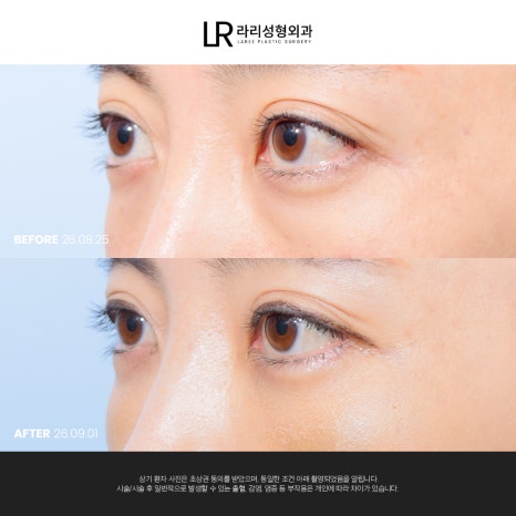 [라리성형외과] 눈 밑이 피곤해 보이는데 눈 밑에 지방만 빼면 될까?(눈밑지방재배치수술 VS 하안검수술) 관련 이미지 9