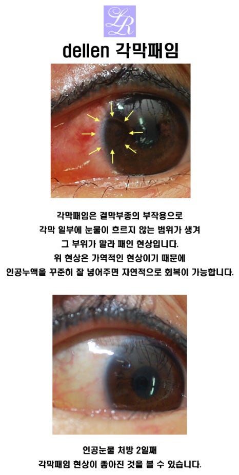 눈 뒤트임에 대한 오해 (feat. 부작용?) 관심있다면 꼭 봐주세요! 관련 이미지 10