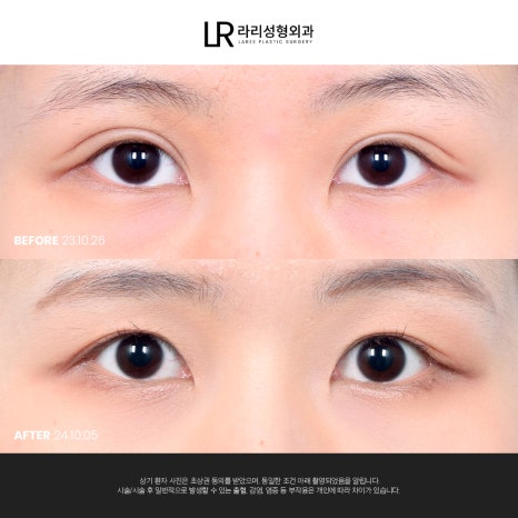 [라리성형외과] 눈 (재) 수술은 라리성형외과가 관련 이미지 6