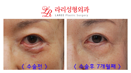 Complications of Lower Blepharoplasty: Ectropion Correction (Senile, Traumatic, Iatrogenic) image 1
