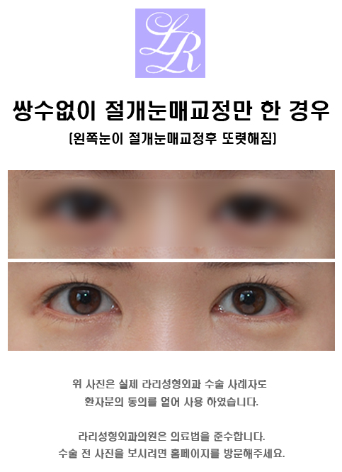 Comparing Swelling After Incisional Ptosis Correction vs. Incisional Double Eyelid Surgery image 2