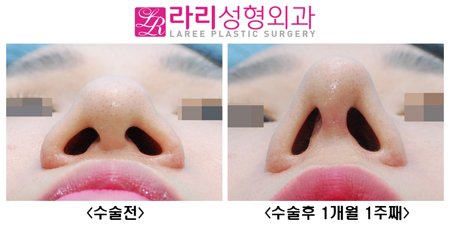[Rari Plastic Surgery] Nose Bridge and Tip Surgery After Hyco Removal image 6