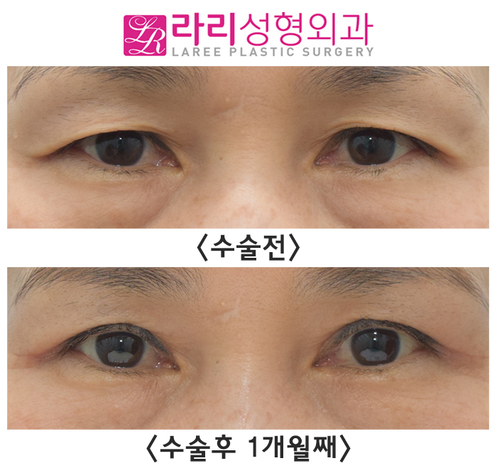 [라리성형외과] 처진 피부에 가려진 내 큰 눈 찾아주는 상안검수술 전후 사진 관련 이미지 4