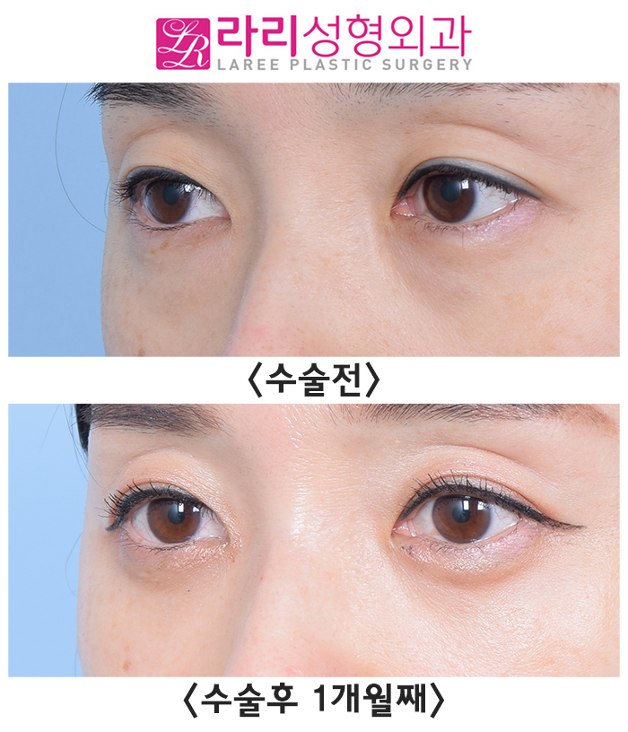 [라리성형외과] 눈밑지방재배치수술로 근본적인 문제를 해결하자(레이저보다 확실한 방법) 관련 이미지 1