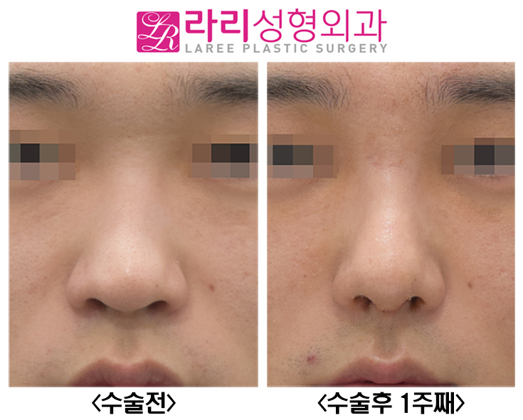 [Lari Plastic Surgery] Before-and-After Photos of Male Rhinoplasty with Rib Cartilage image 3