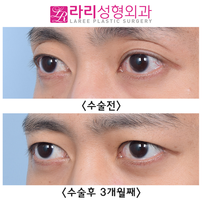 [Lari Plastic Surgery] Bulging Eyes? Sunken Eyes? Smoother with Fat Grafting and Double Eyelid Removal image 3