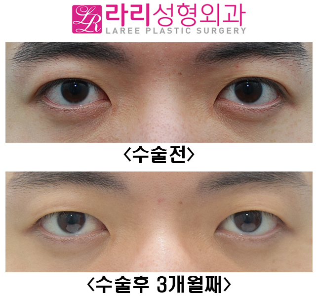 [Lari Plastic Surgery] Before-and-After Photos of Male Double Eyelid Removal Surgery at 3 Months image 1