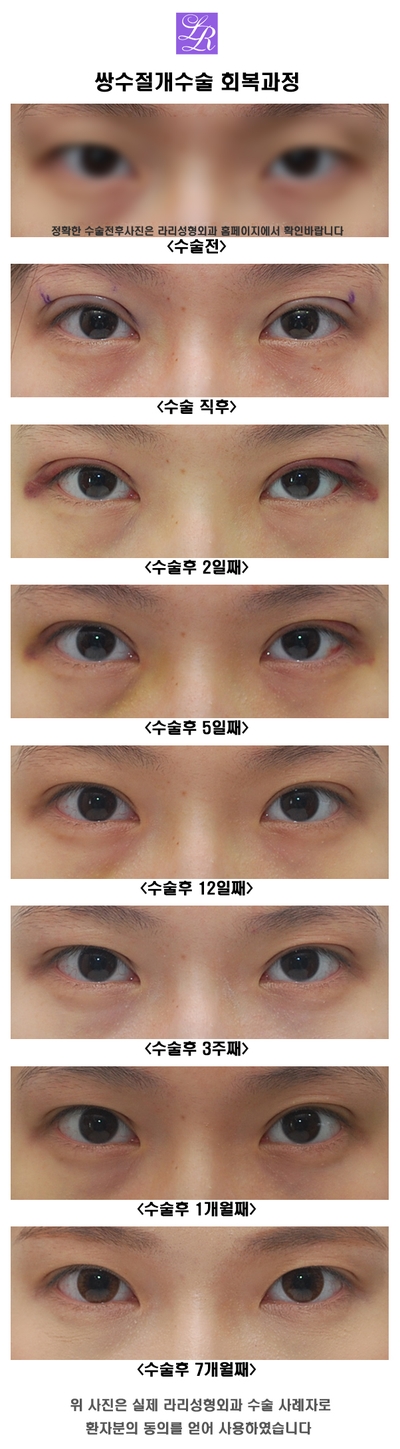 Comparison of In-Out Double Eyelid Shapes image 4