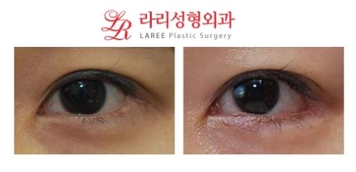 뒤트임/뒤트임재수술/뒷트임재수술 전후사진 관련 이미지 1