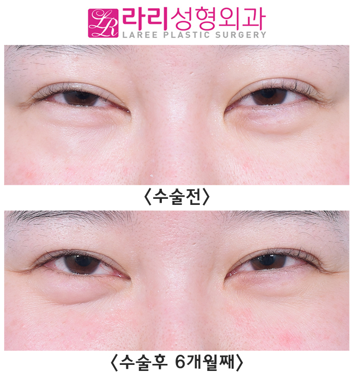 [라리성형외과] 눈밑이물질(스컬트라)제거 수술 전후 사진 차이 관련 이미지 2