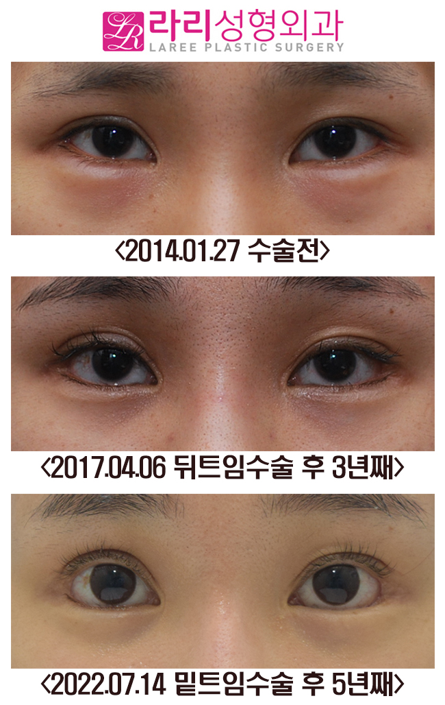 [라리성형외과] 뒤트임, 밑트임 수술 후 장기경과 전후사진 관련 이미지 1