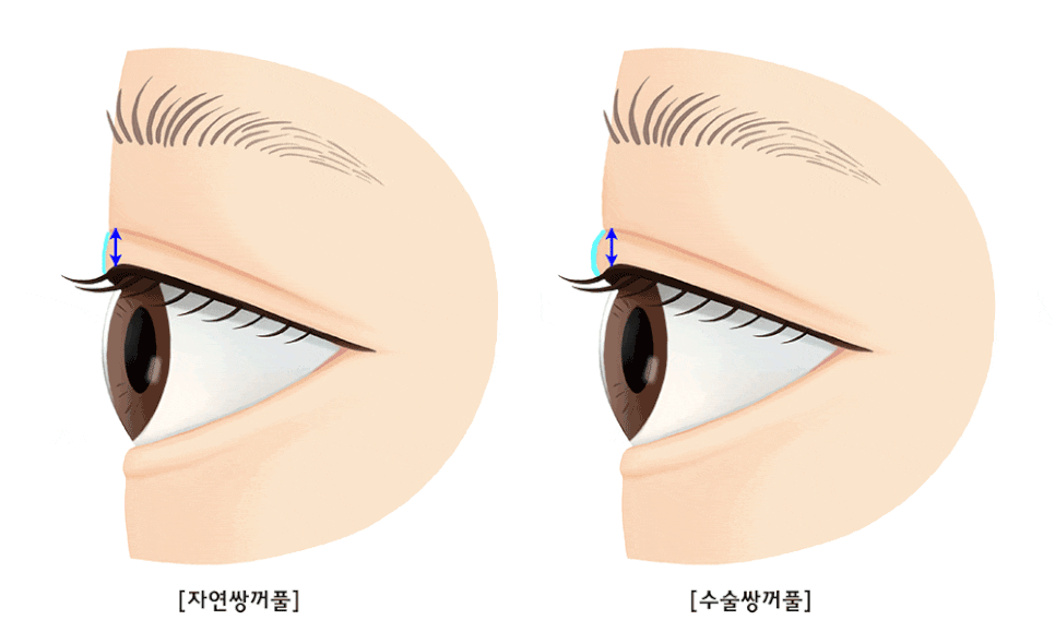 [Lari Plastic Surgery] One-sided double eyelid surgery to correct uneven eyes: Is it possible to get double eyelids on only one eye? image 2