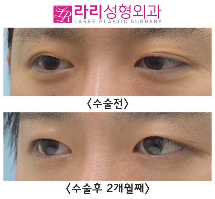 [Rari Plastic Surgery] Before-and-After Photos of Surgery to Remove a Folded Double Eyelid After Incisional Double Eyelid Surgery image 3