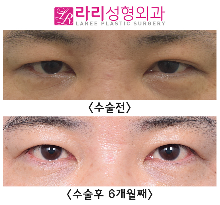 [Rari Plastic Surgery] Before and After Surgery to Remove Uneven Natural Double Eyelids Accompanied by Sagging Skin image 1
