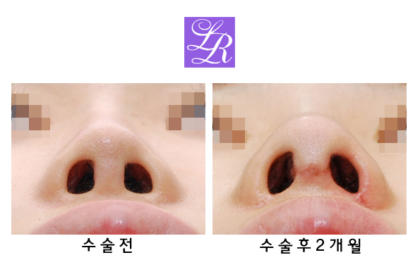 Short Upturned Nose Revision Surgery: Rib Cartilage Is Essential! (feat. Alar Reduction) image 4