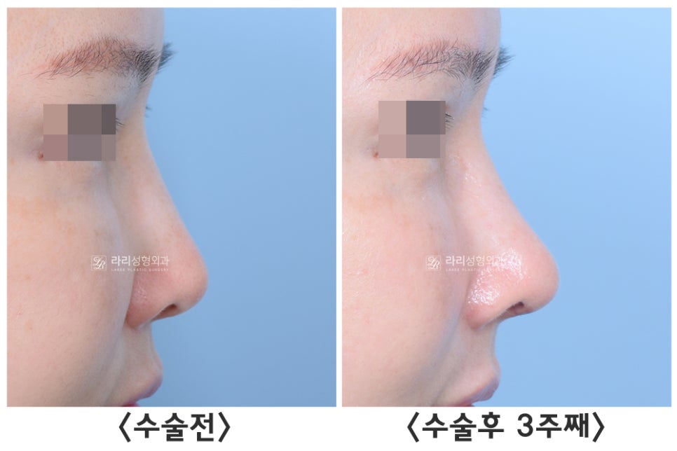 [라리성형외과] 자가늑연골을 이용한 여러 가지 코 수술 : 고난이도 코성형의 핵심 재료 관련 이미지 5