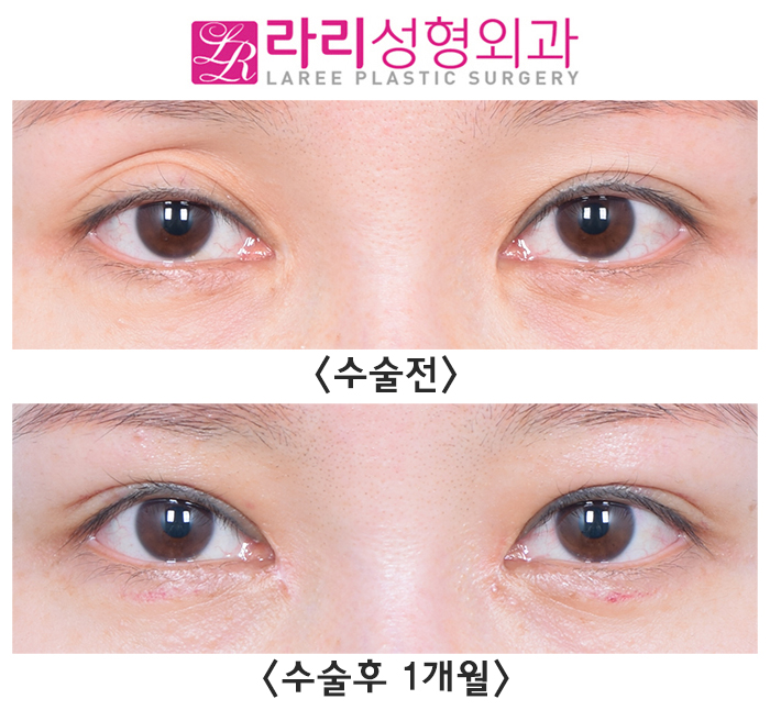 [라리성형외과] 피곤해 보이는 눈, 윗눈꺼풀 지방이식과 쌍수재수술로 예쁘게 재탄생 관련 이미지 1