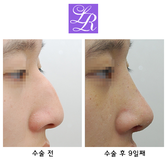 휘어진코? 휜코? 매부리코? 메부리코? 교정 관련 이미지 5