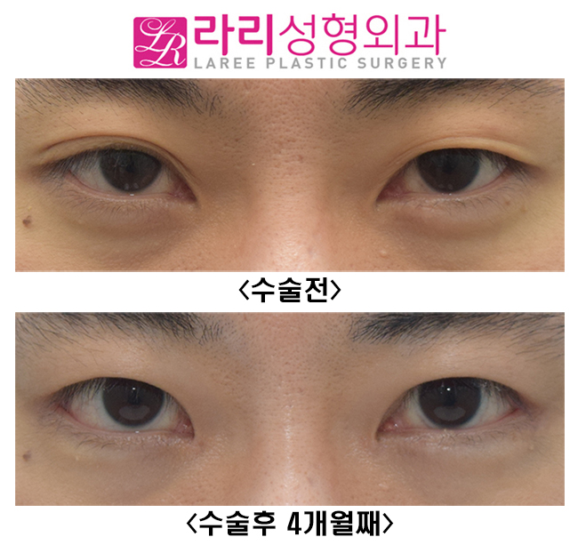 [라리성형외과] 쌍꺼풀없애는수술+ 트임없는앞트임수술+ 눈꼬리내리기뒤트임수술 = 또렷한 눈, 남자다운 눈, 멋있는 눈 관련 이미지 1