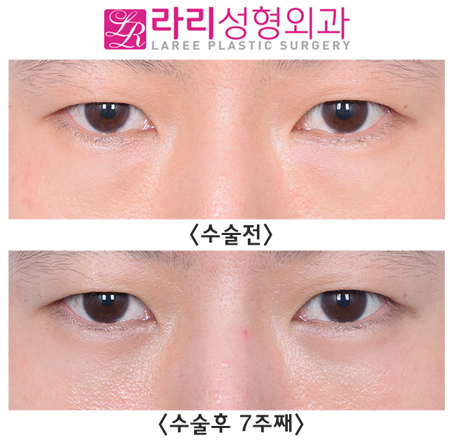 [Lari Plastic Surgery] Check for Undetected Under-Eye Fat and Solve It with Under-Eye Fat Repositioning. image 1