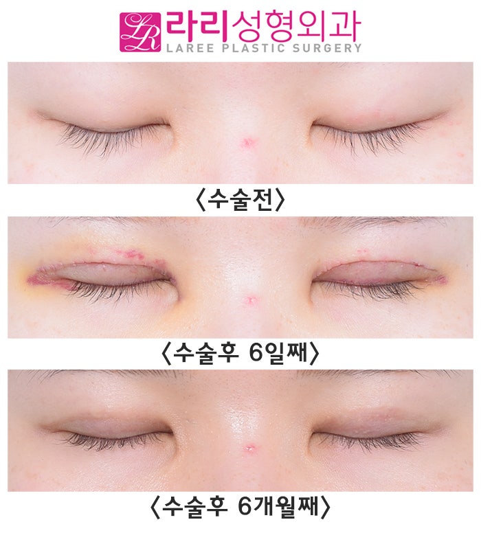 [Lari Plastic Surgery] Incisional Eye Correction Surgery for a Hidden Double Eyelid in a Monolid: Swelling Period Before and After (+Selfie) image 2